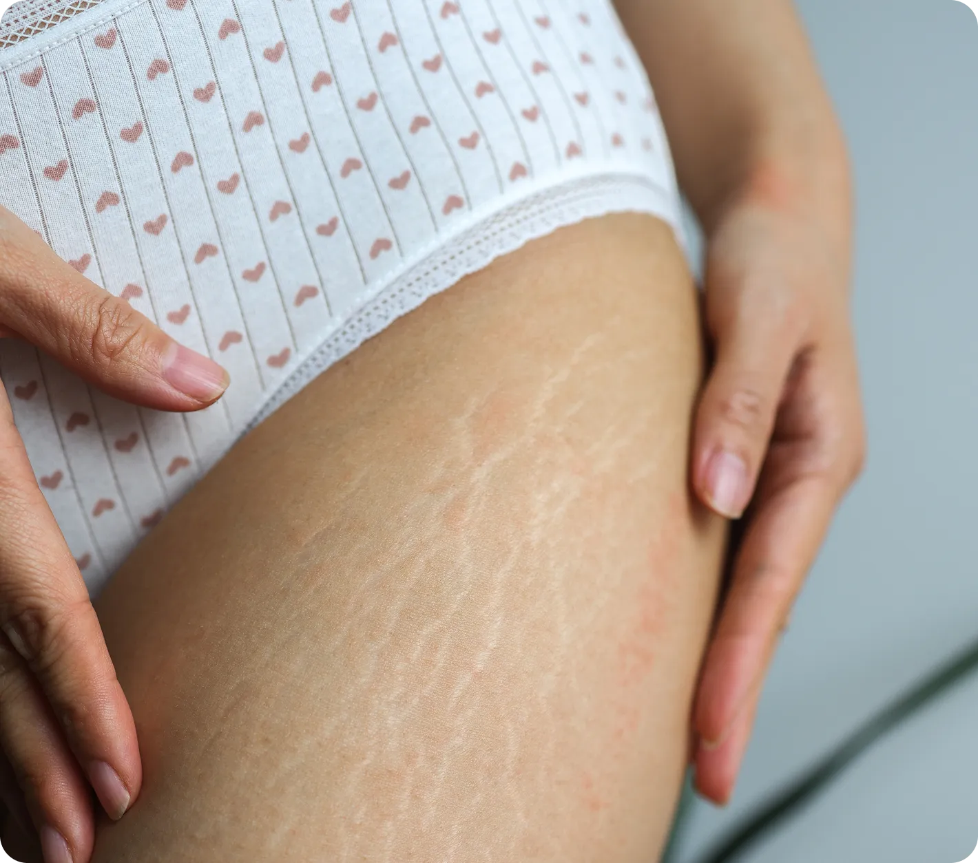 Body Skin Quality & Stretch Marks Treatment