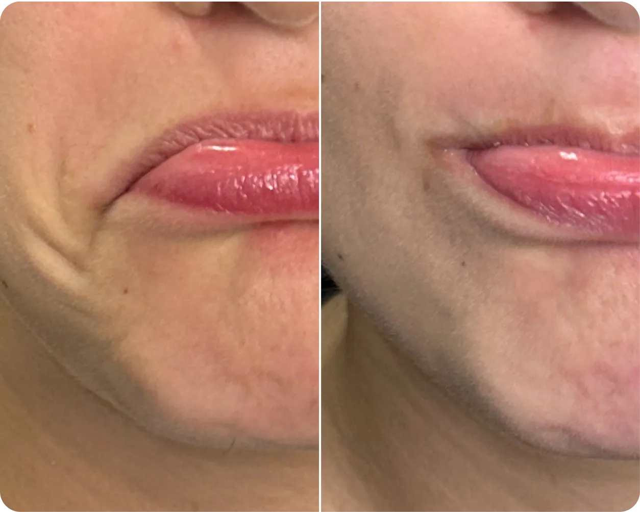 Before and after Botox frown lines at AlyneMD — precision neuromodulator treatment