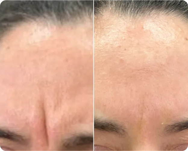 Before and after Botox forehead lines at AlyneMD — physician-performed natural results