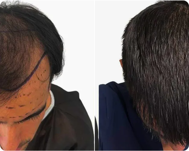 FUE Hair Transplant - before and after 