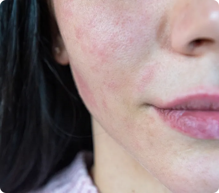 Doctor-Led Rosacea & Facial Redness