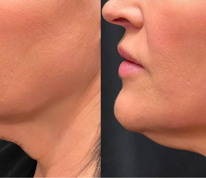 AlyneTight EndoTight laser skin tightening at AlyneMD — double chin and neck contouring