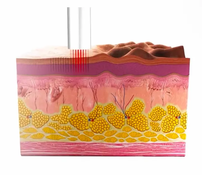 AlyneResurface fractional Er:YAG laser resurfacing at AlyneMD — texture, scars, and pigmentation correction