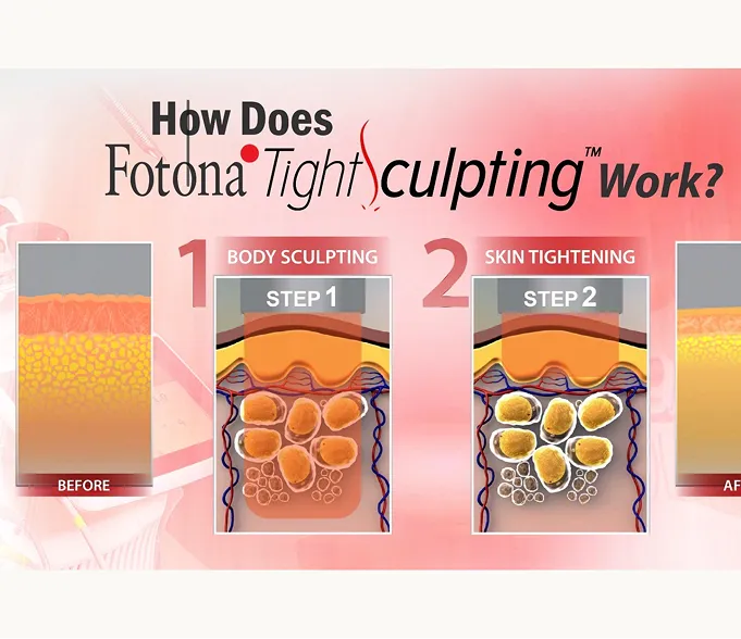 AlyneSculpt Fotona TightSculpting body contouring at AlyneMD — non-surgical abdomen and thigh tightening