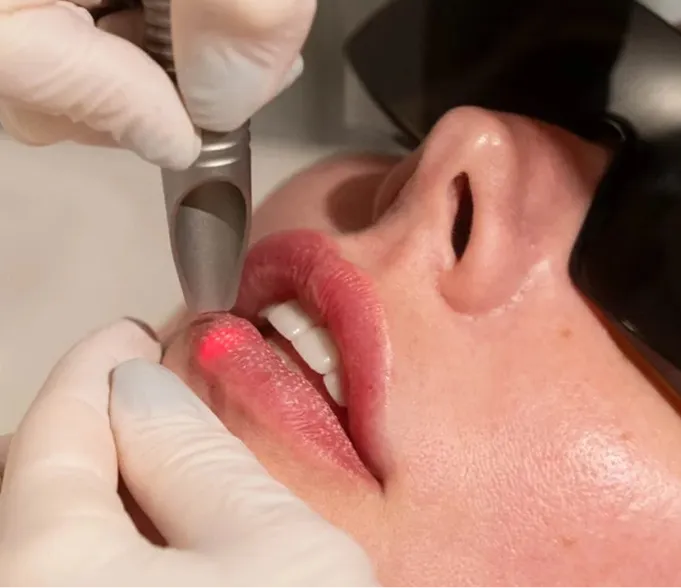 AlyneLip Fotona LipLase non-injectable lip enhancement at AlyneMD — collagen-based lip plumping
