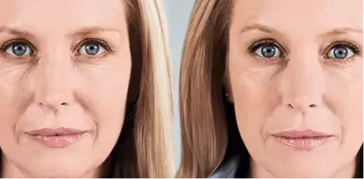 Before and after Sculptra biostimulator results at AlyneMD, restored facial volume