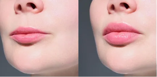 Before and after dermal filler lip enhancement at AlyneMD, natural volume restoration