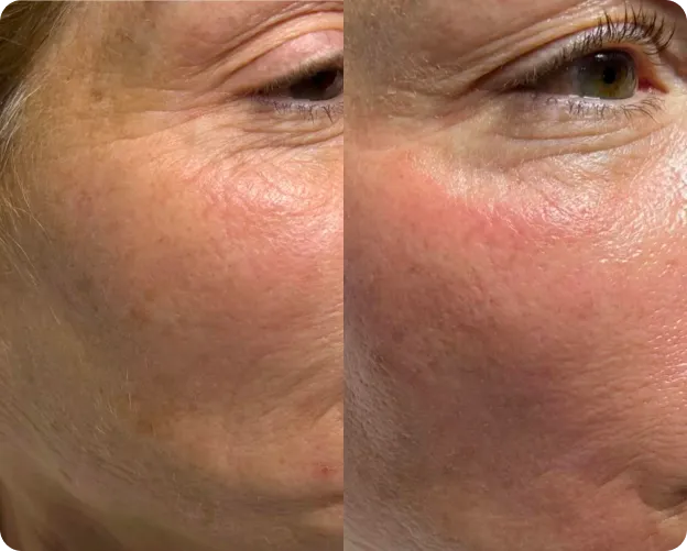 MEDICAL FACIALS before and after