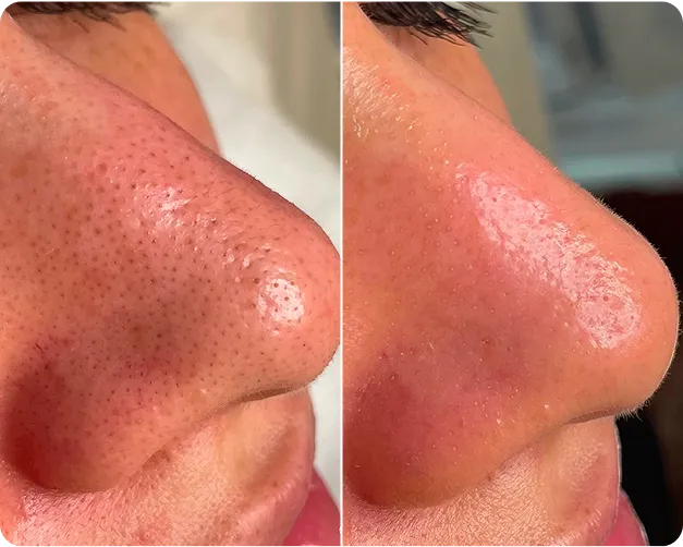 MEDICAL FACIALS before and after