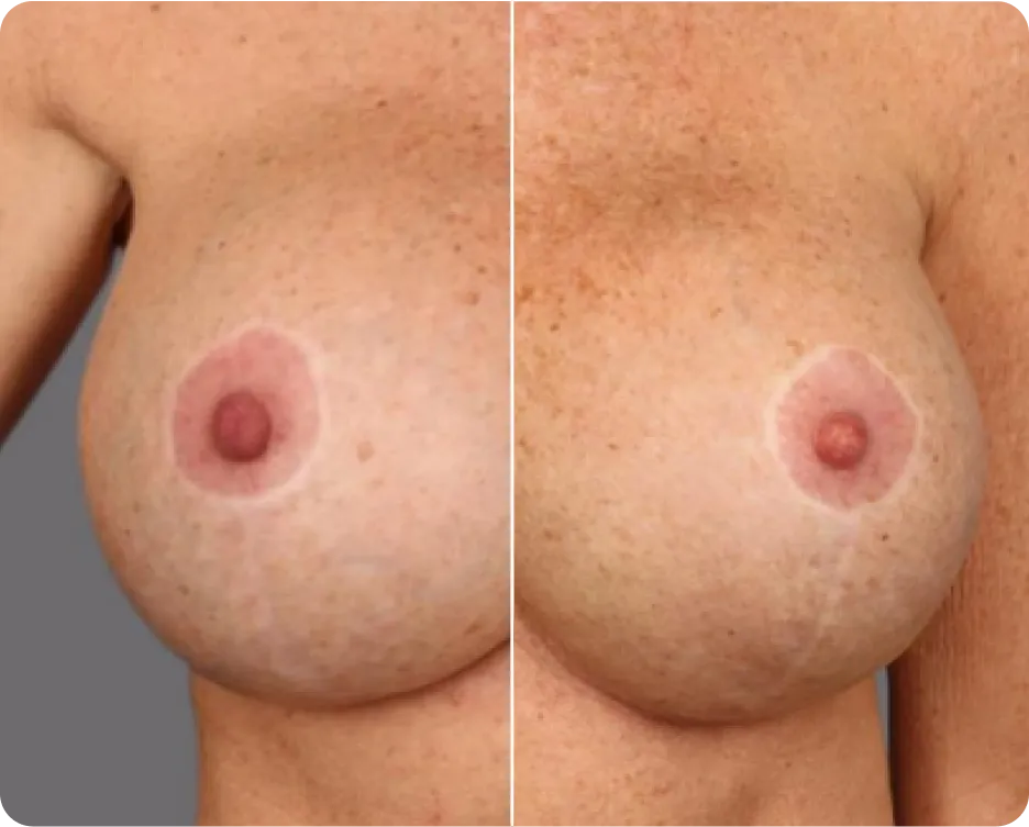 alloClae breast contour and symmetry correction, before and after