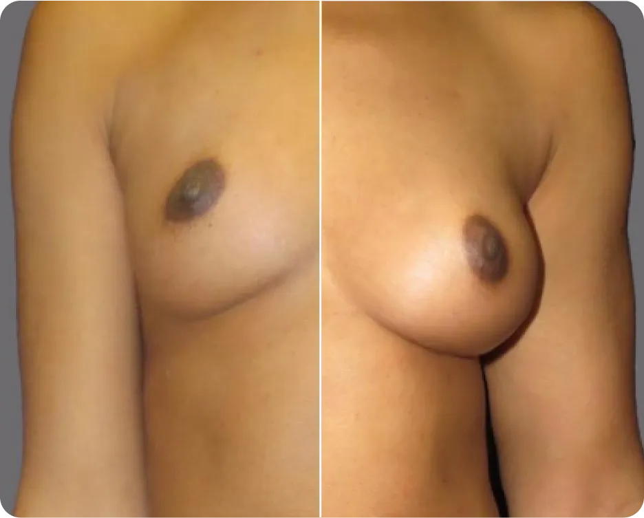 alloClae breast contour restoration, before and after