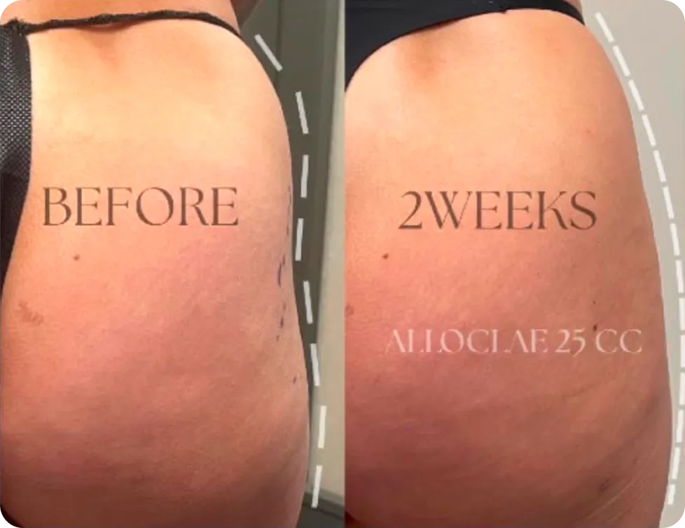 alloClae hip dip contouring, before and two weeks after treatment with 25 mL