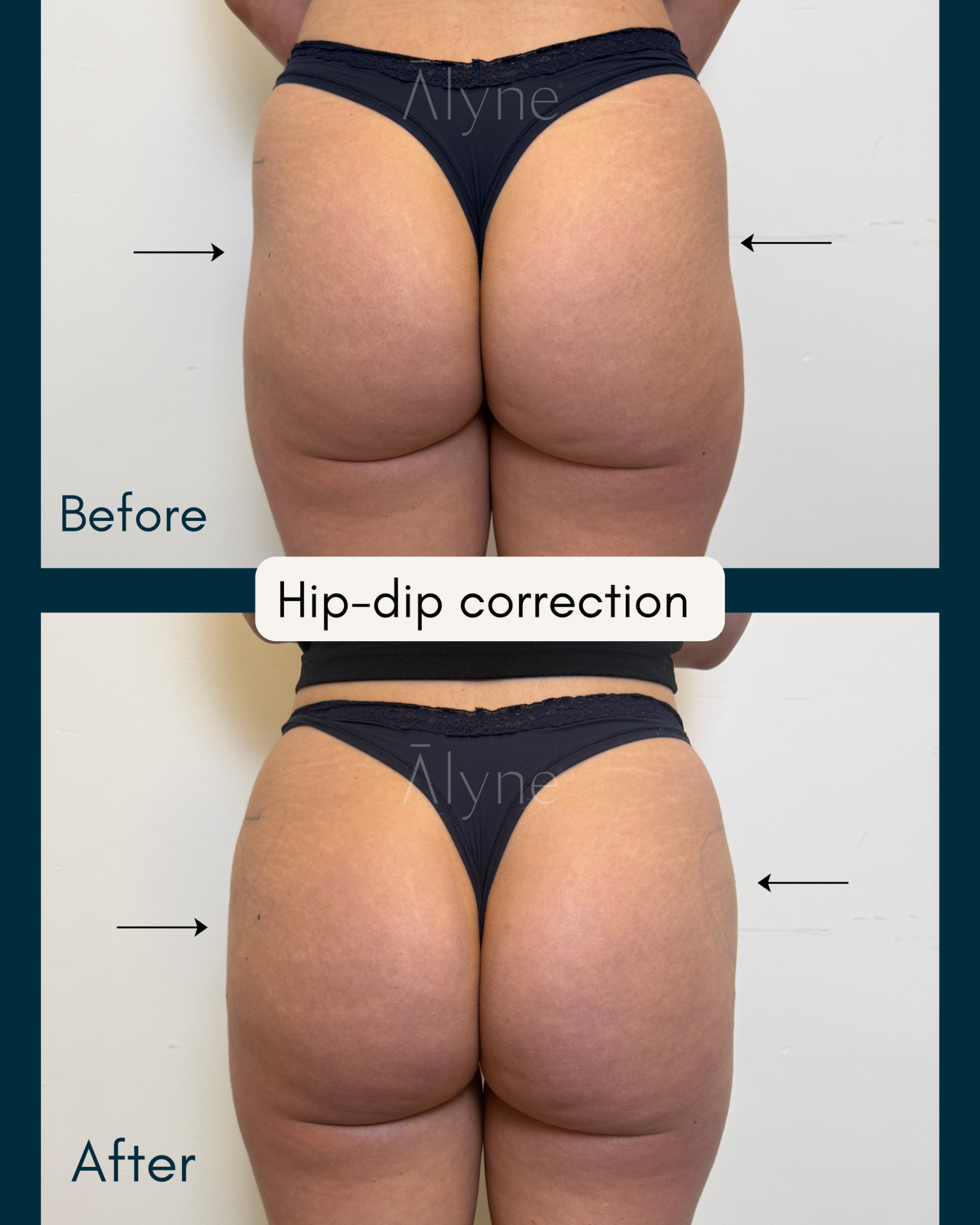 alloClae gluteal contour, before and after