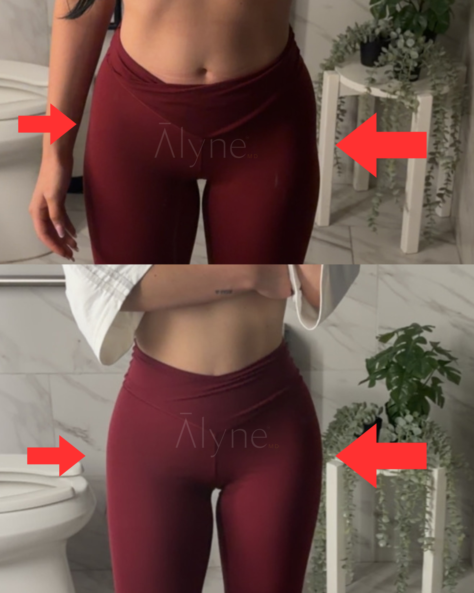 alloClae hip and outer thigh contour smoothing, before and after