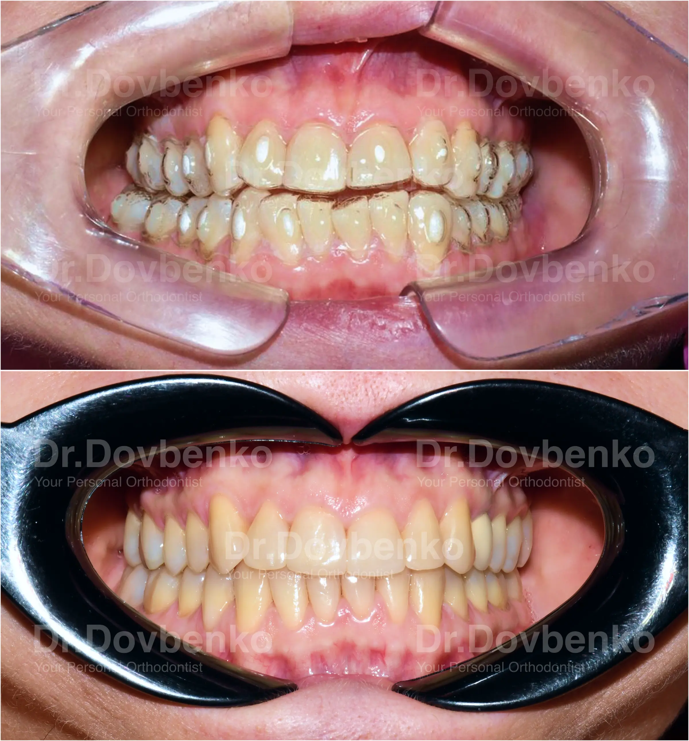 Елайнери. Результат До та Після