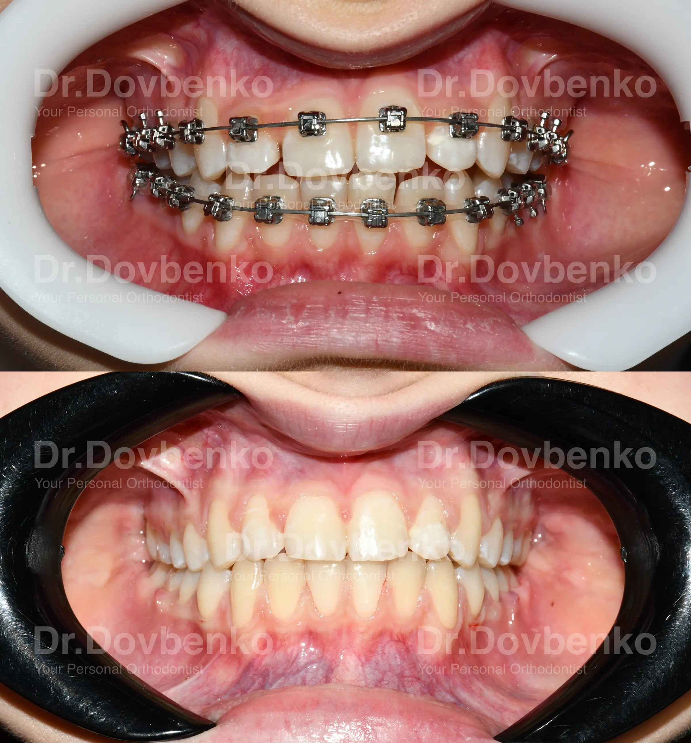 Брекети. Результат До та Після