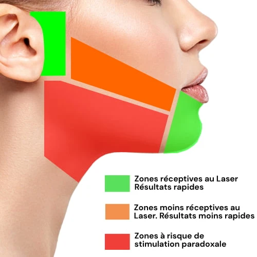 Les zones du visage, cou-joue, à risque de stimulation paradoxale aux centres laser murano
