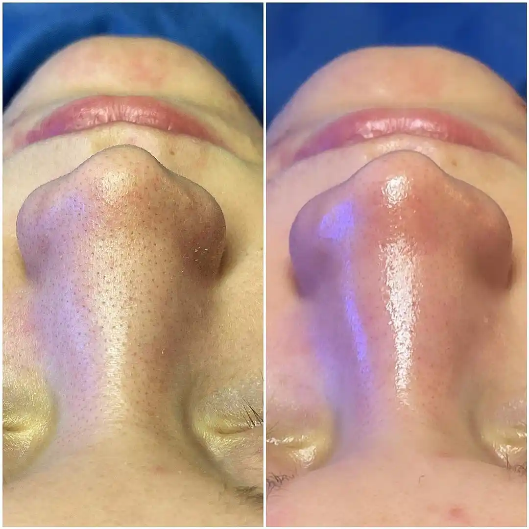 L'Hydrafacial, une photo du nez avant/après, aux centres laser murano