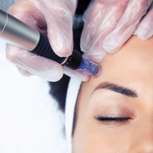 Le Microneedling Mésolift sur le visage aux Centres laser murano