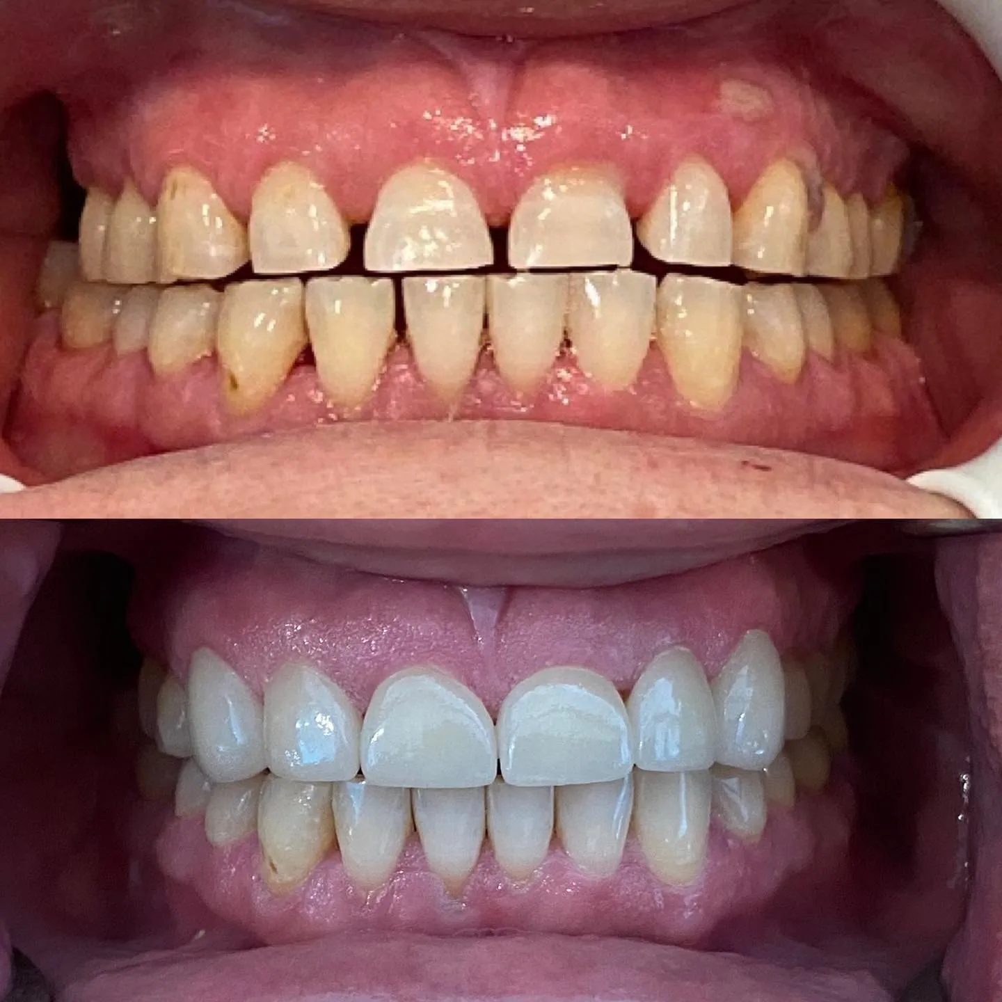 Rosa Before and After Invisalign and Cleaning and crowns