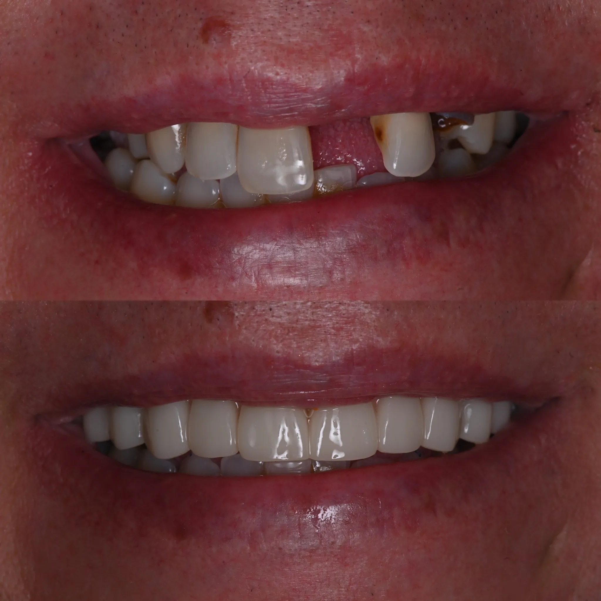 Full-arch dental restoration with All-on-X implants
