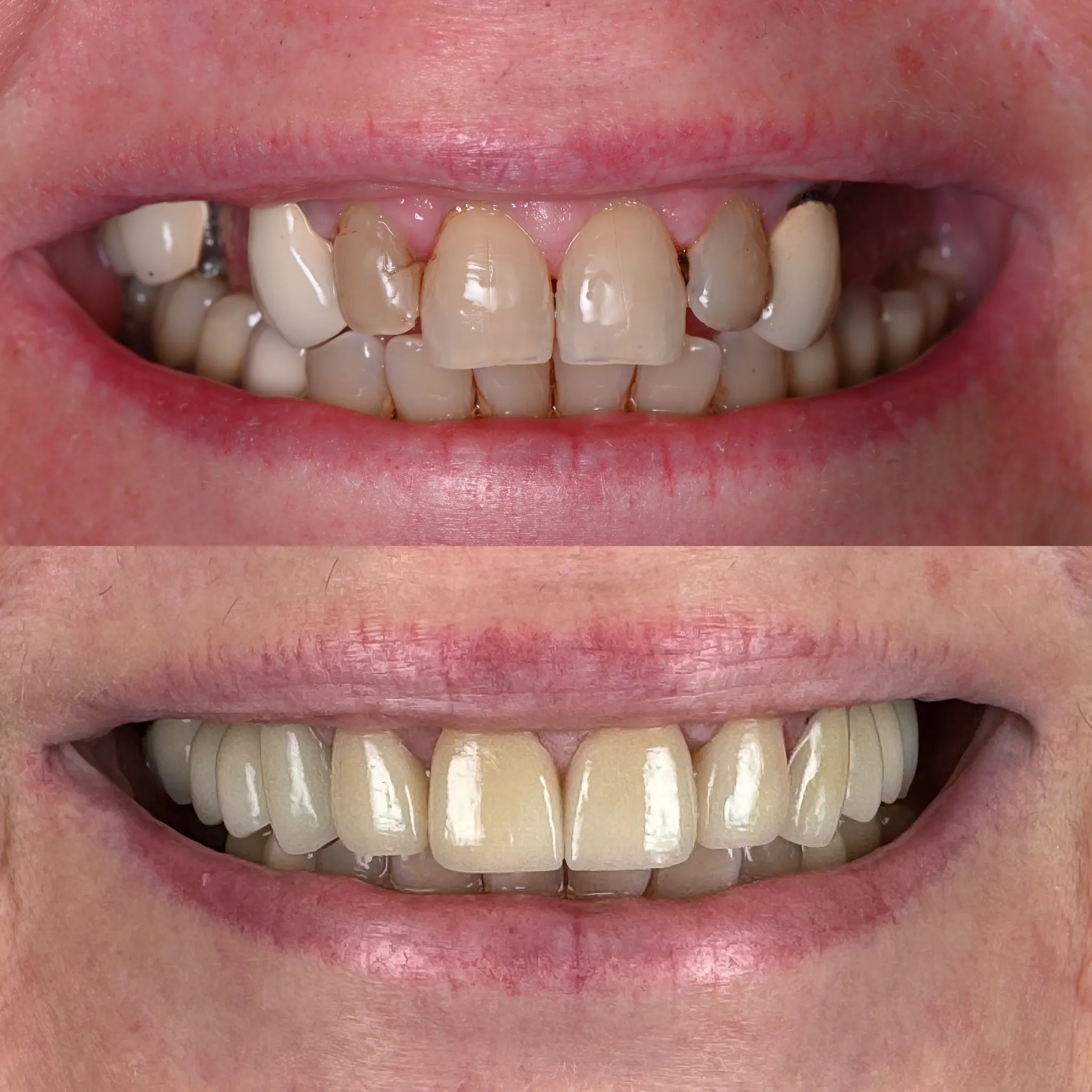 Linda Before and After Full Mouth Rehab Crowns Implants