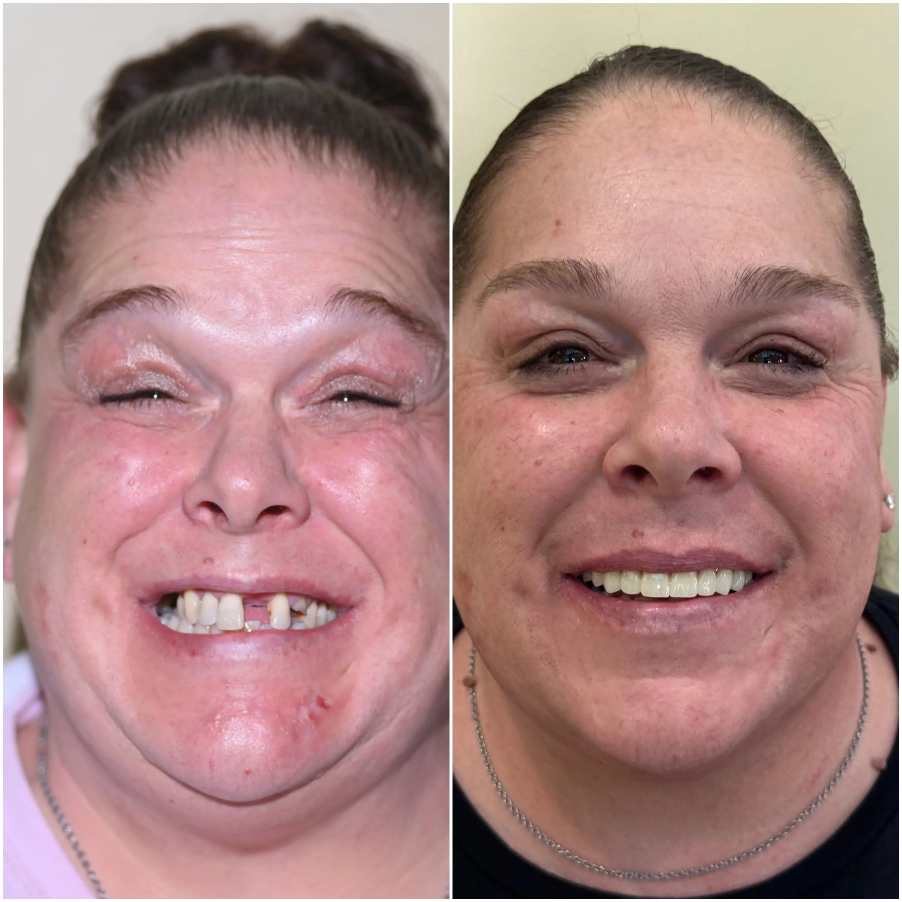 Happy patient displaying a brighter and healthier smile following dental treatment