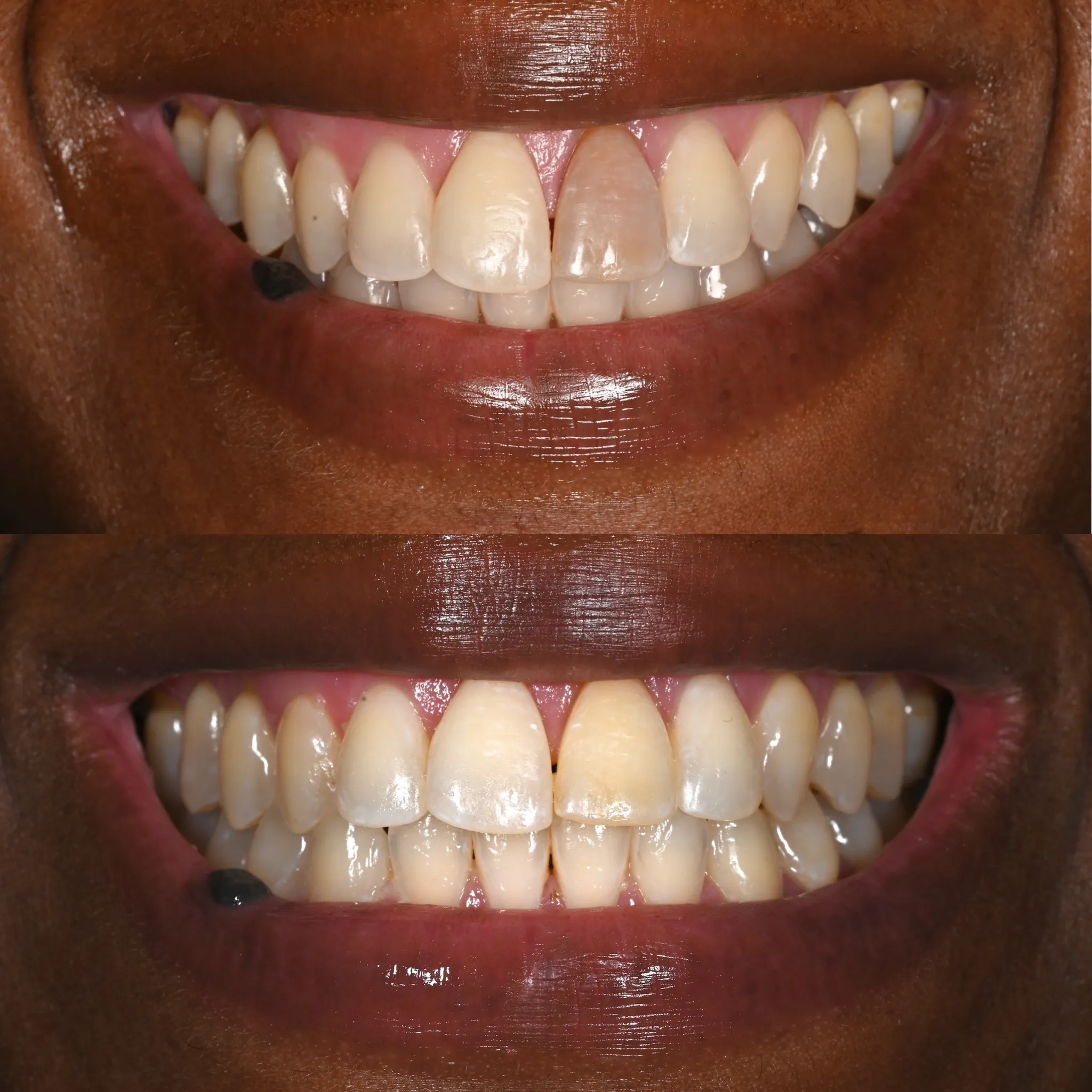 Shaniesha before and after internal bleaching - Legacy Dental