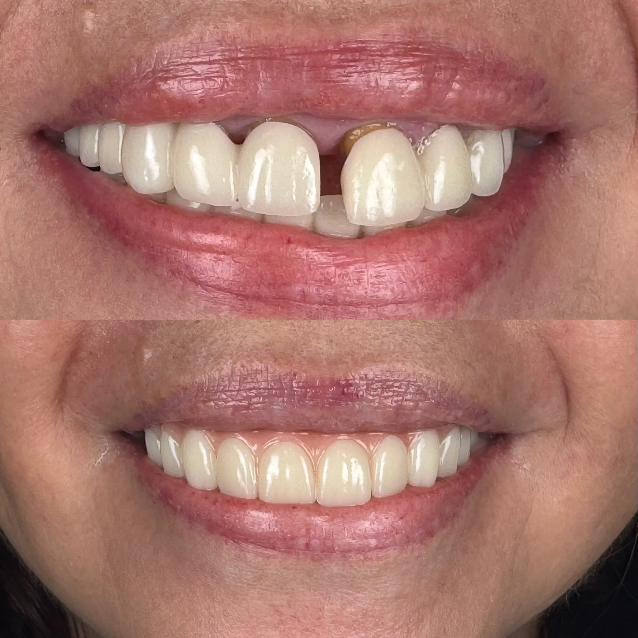 Smile transformation using All-on-X full-arch dental implants