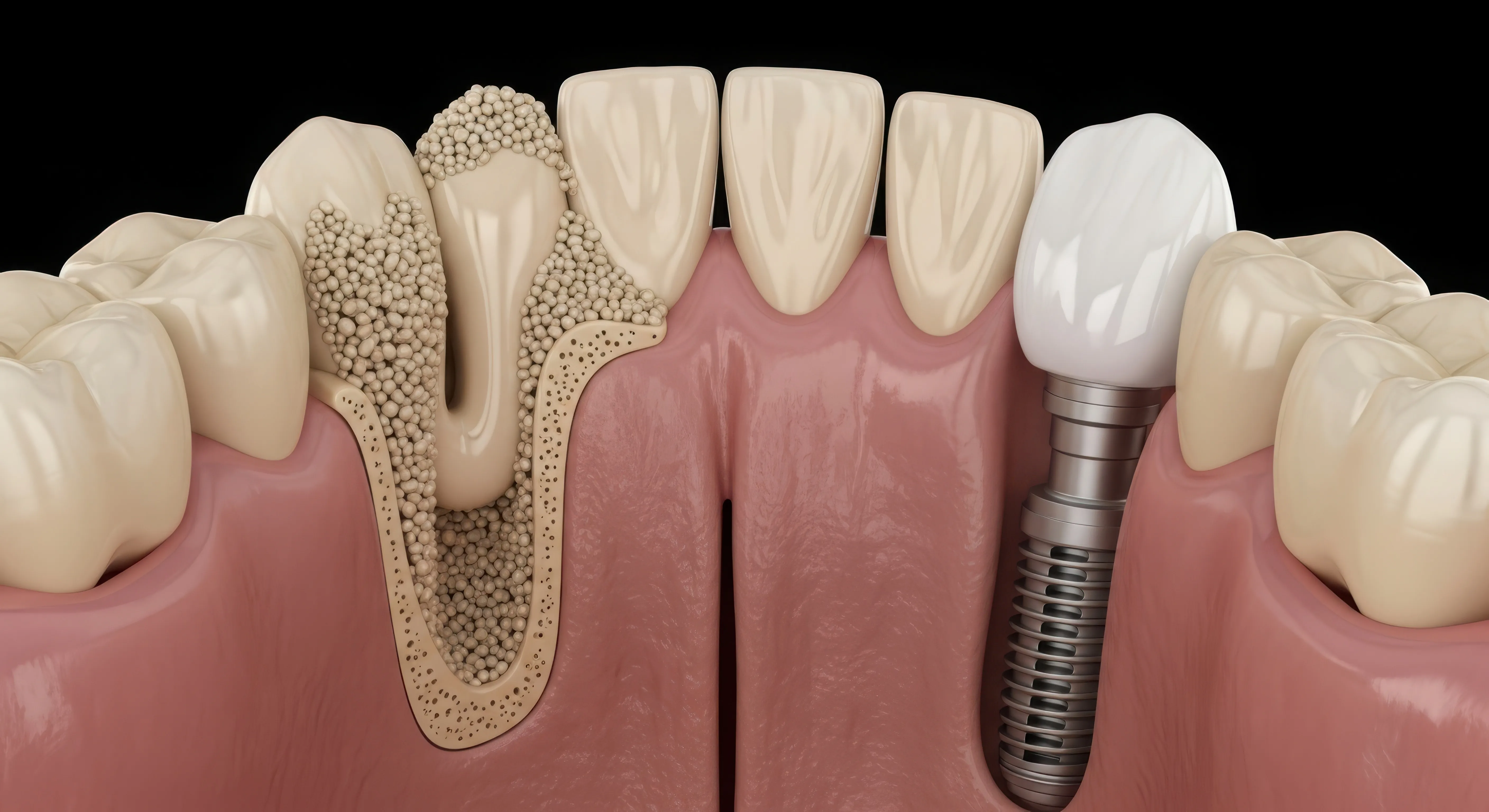 Illustration explaining what dental implant placement and restoration involves for replacing missing teeth"