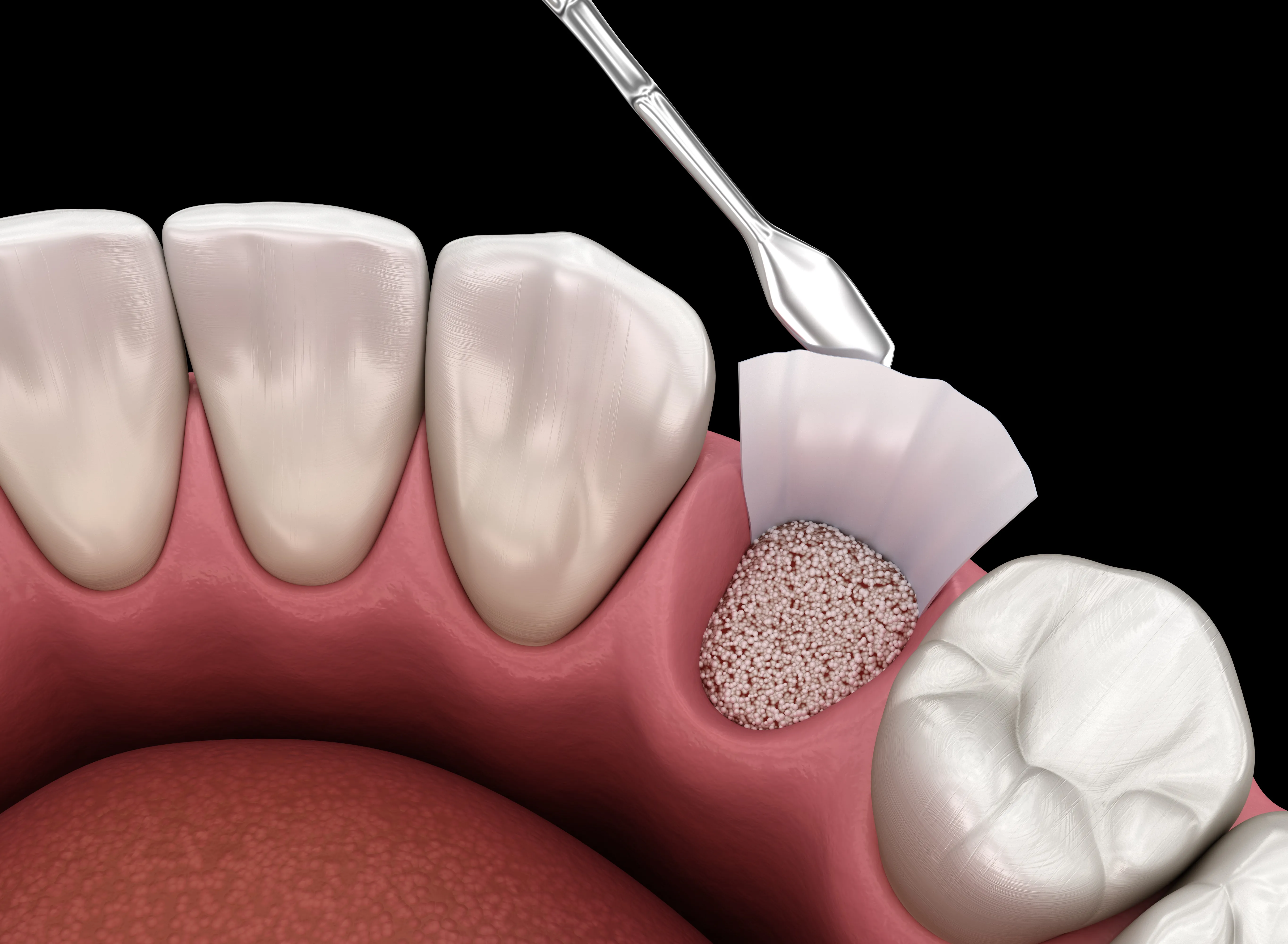 Diagram explaining bone grafting and sinus augmentation procedures for dental implant preparation