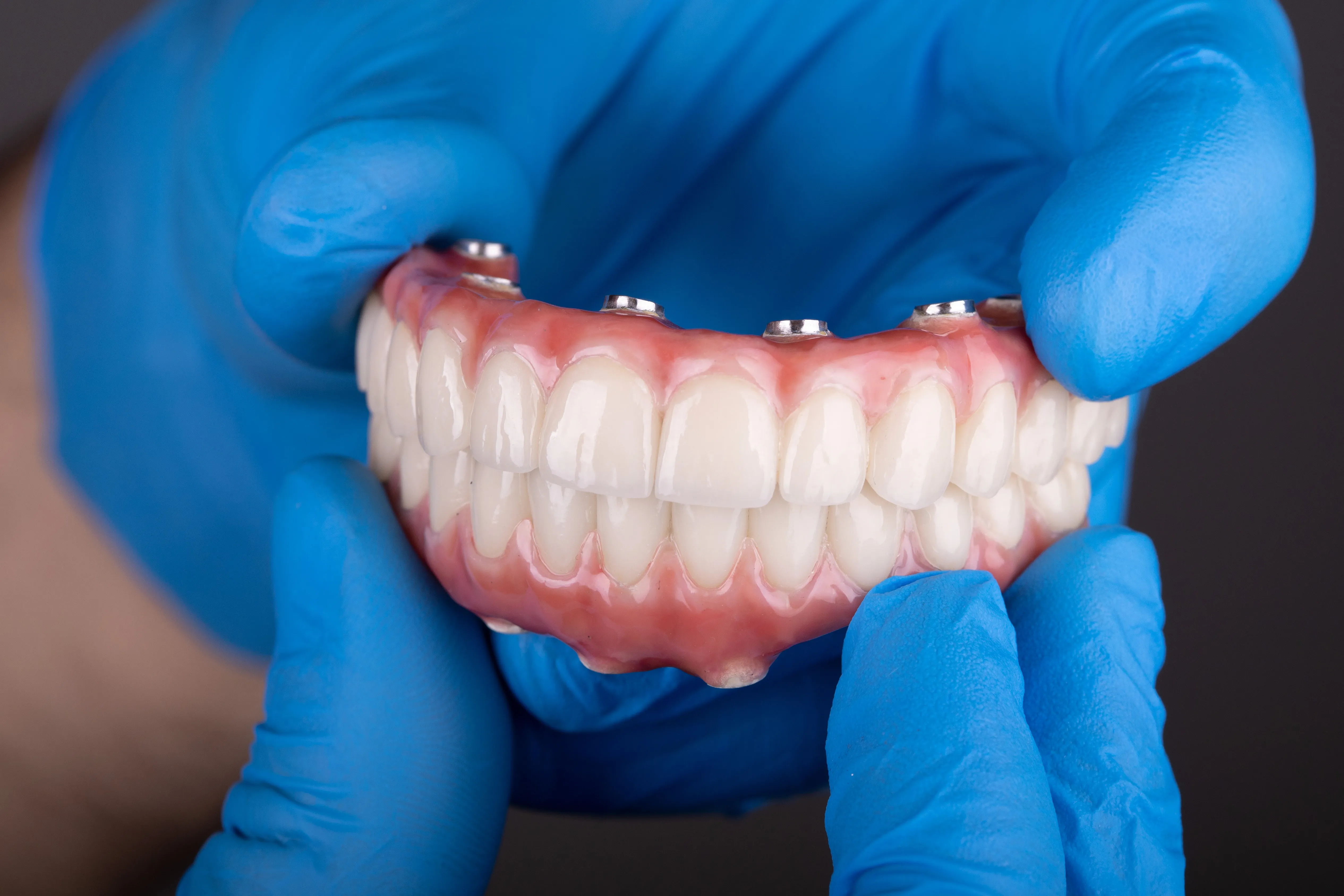 Transformative All-on-X dental implant procedure at Legacy Dental Pasadena