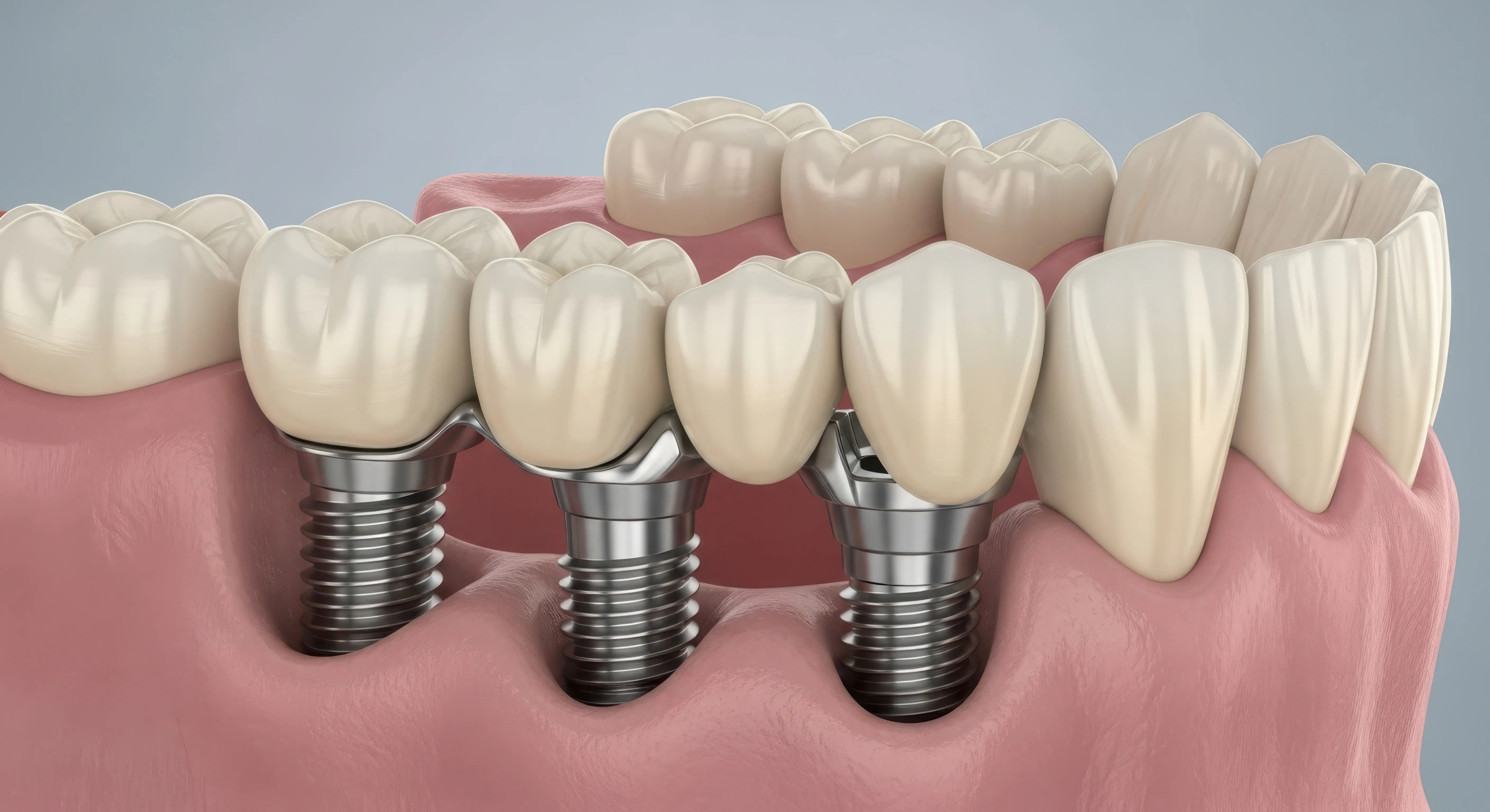 Patient receiving dental implant placement and restoration consultation at Legacy Dental Pasadena