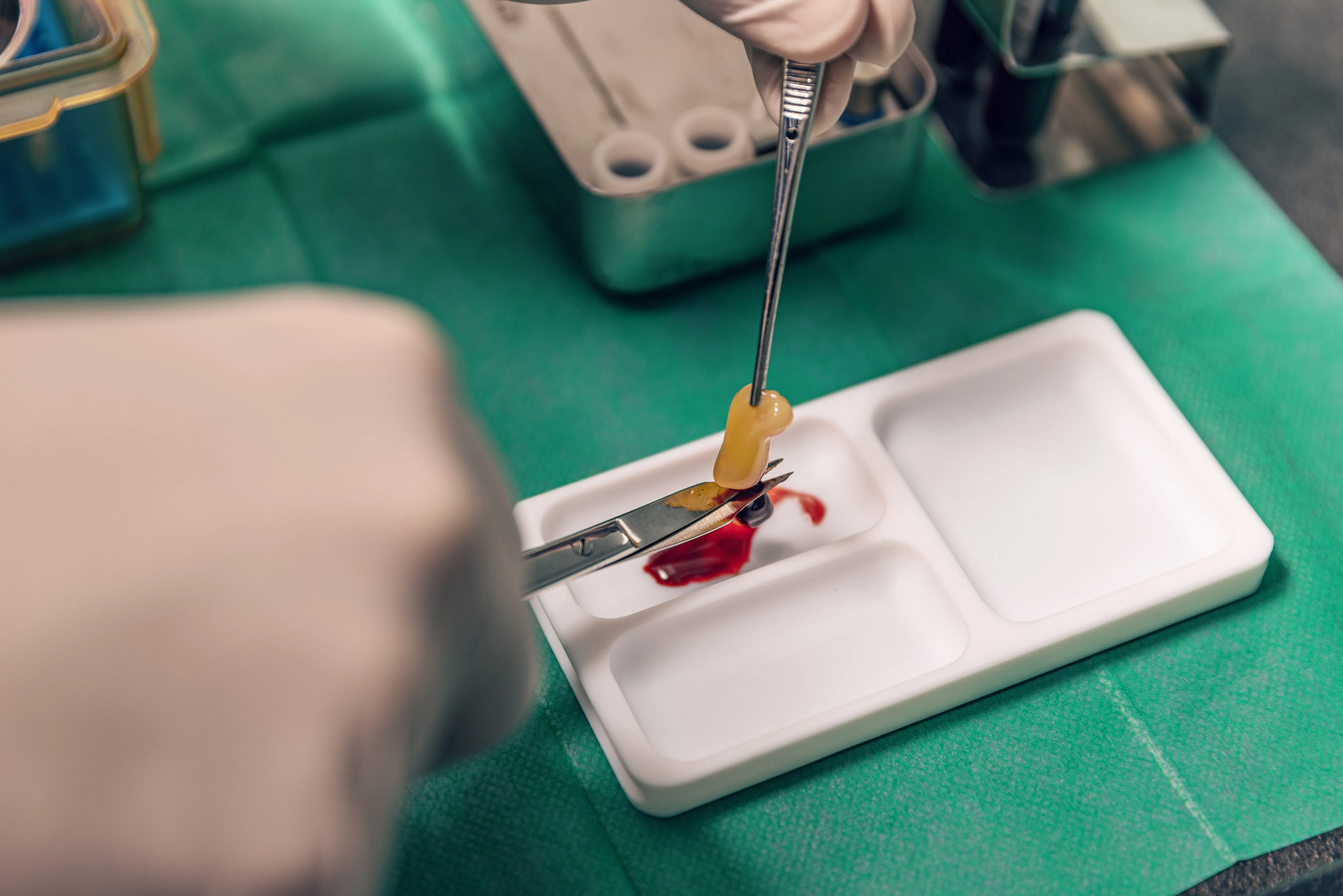 Patient undergoing Platelet Rich Fibrin (PRF) treatment to enhance healing after dental surgery at Legacy Dental Pasadena