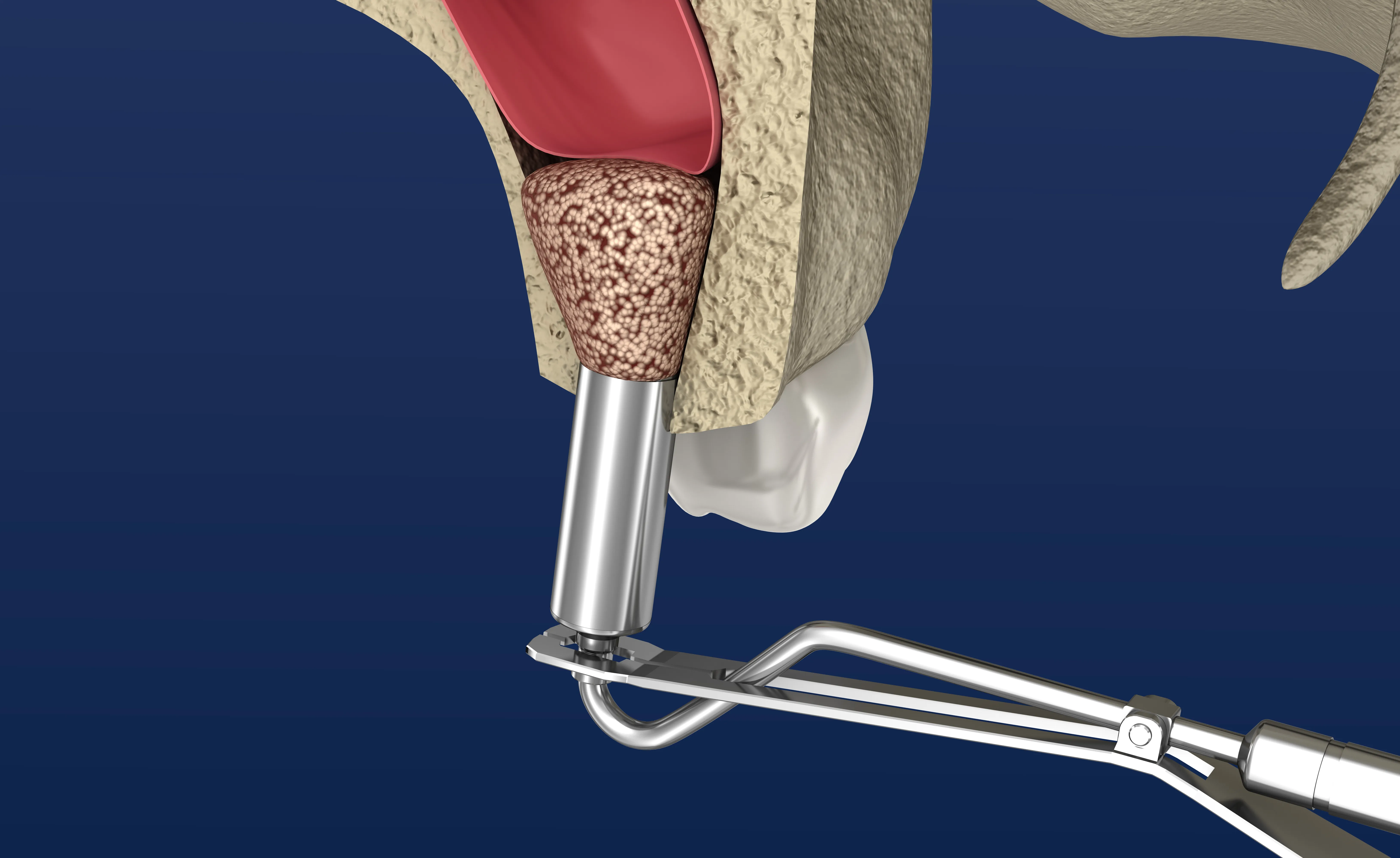 Patient undergoing bone grafting and sinus augmentation to prepare for dental implants at Legacy Dental Pasadena