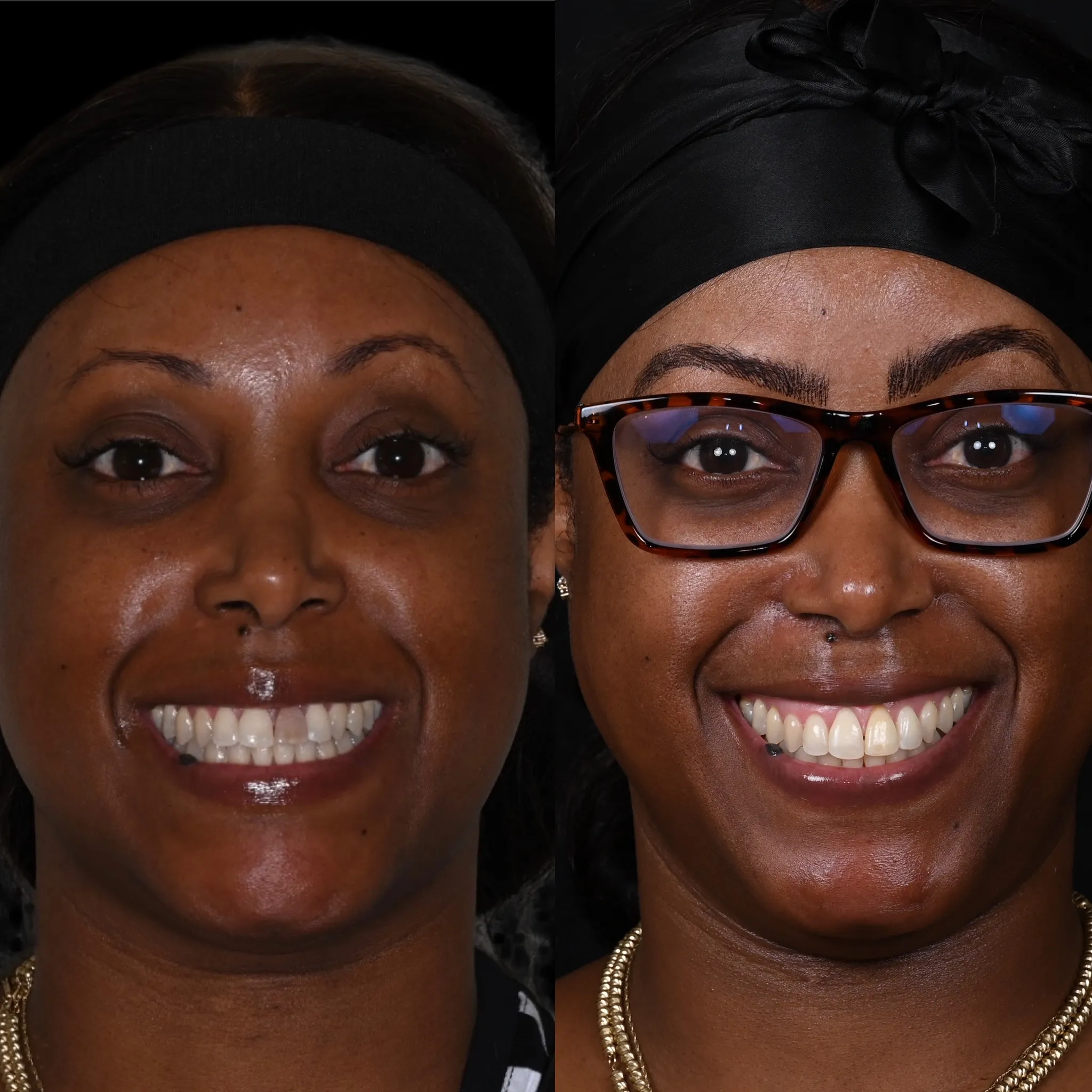 Patient learning what a cosmetic smile makeover involves, including teeth whitening, veneers, and alignment adjustments