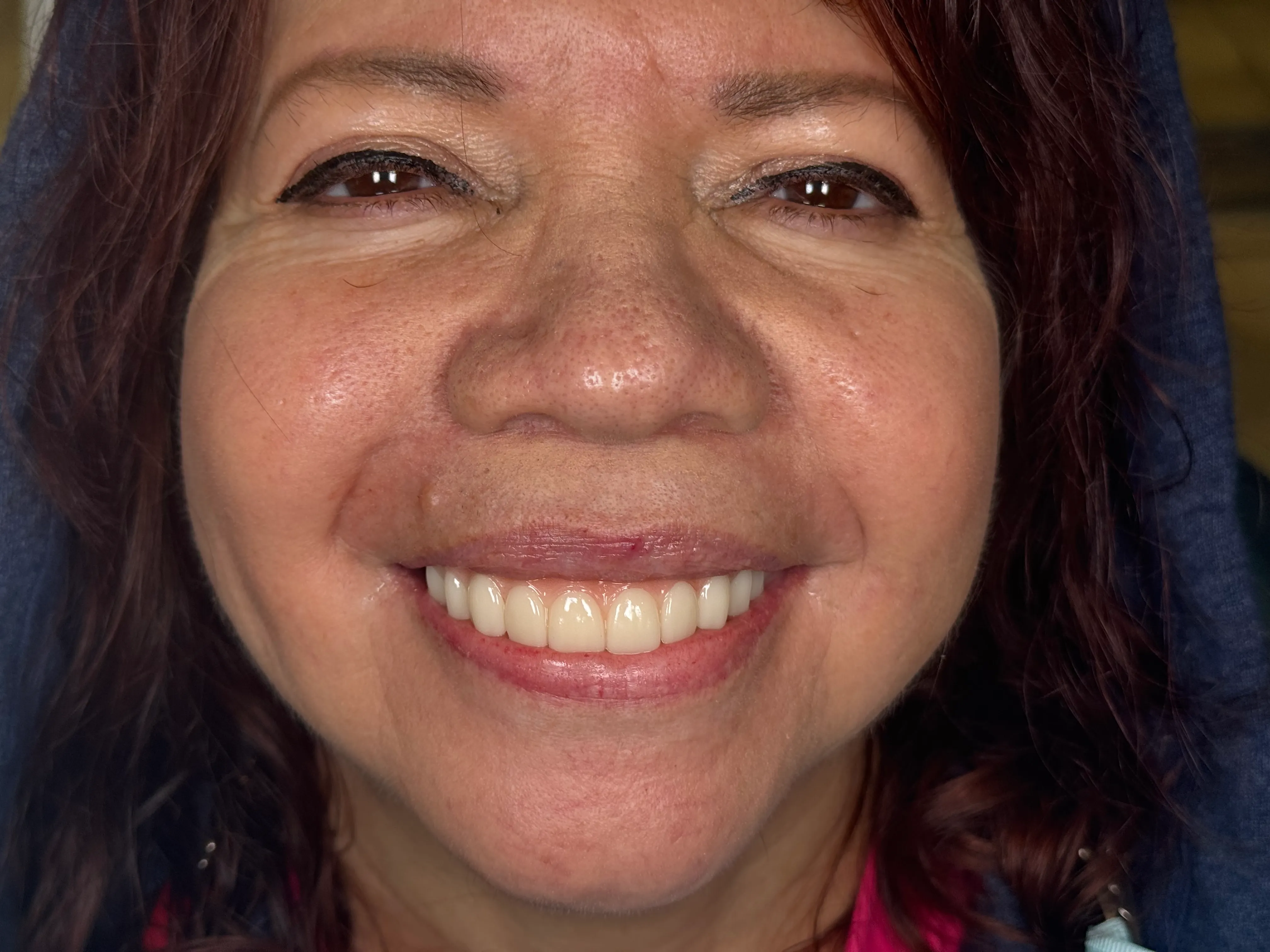 Patient before and after All-on-X dental implant transformation