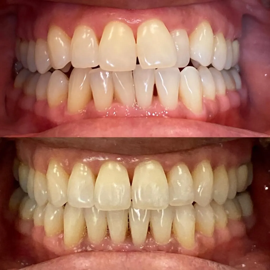 Before and after teeth alignment using Invisalign® clear aligners