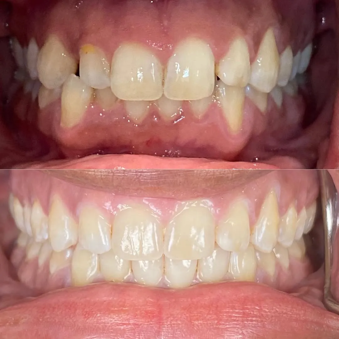 Patient smile transformation with Invisalign® orthodontic treatment