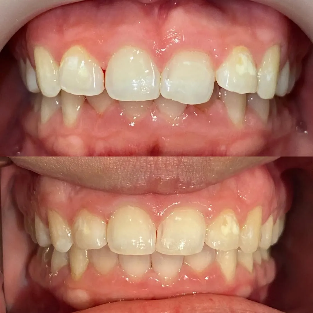 Before and after teeth alignment using Invisalign® clear aligners