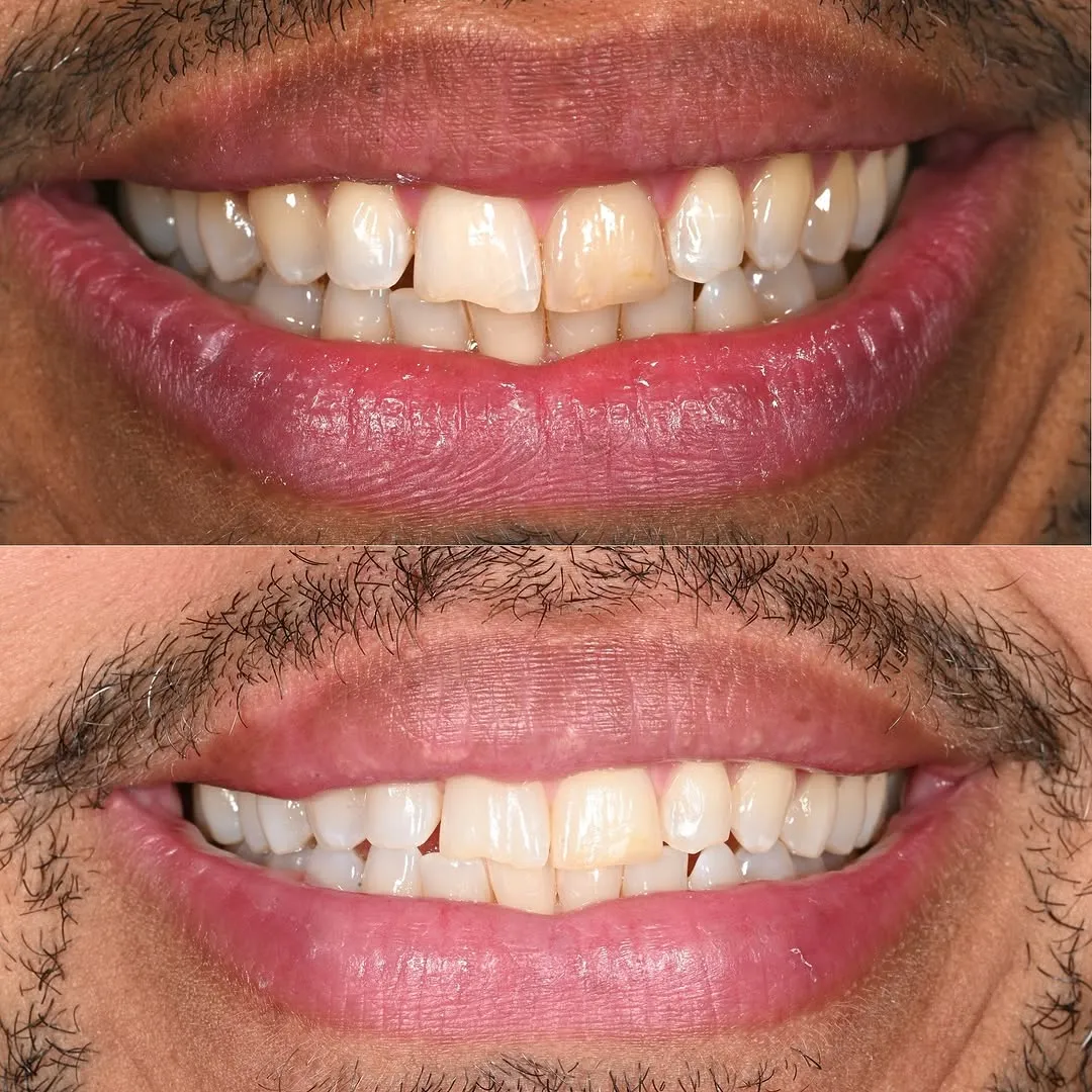 Comparison of teeth before and after internal whitening treatment