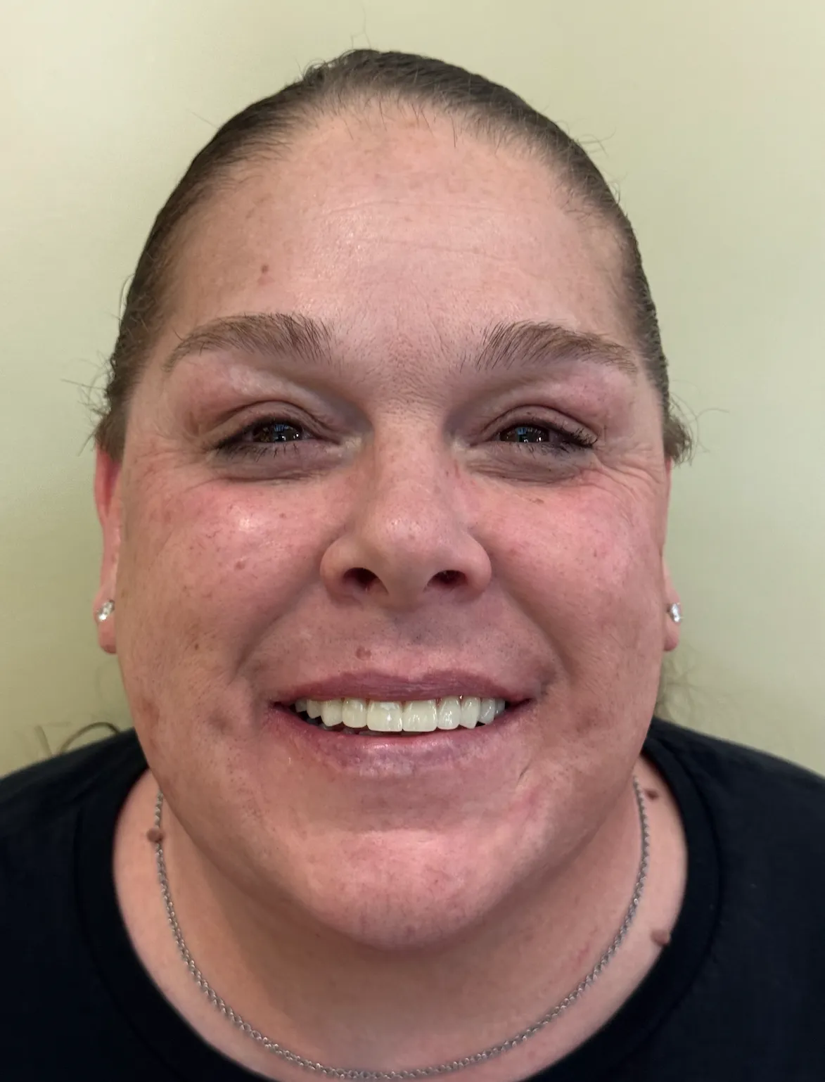 All-on-X dental implant procedure results on patient teeth