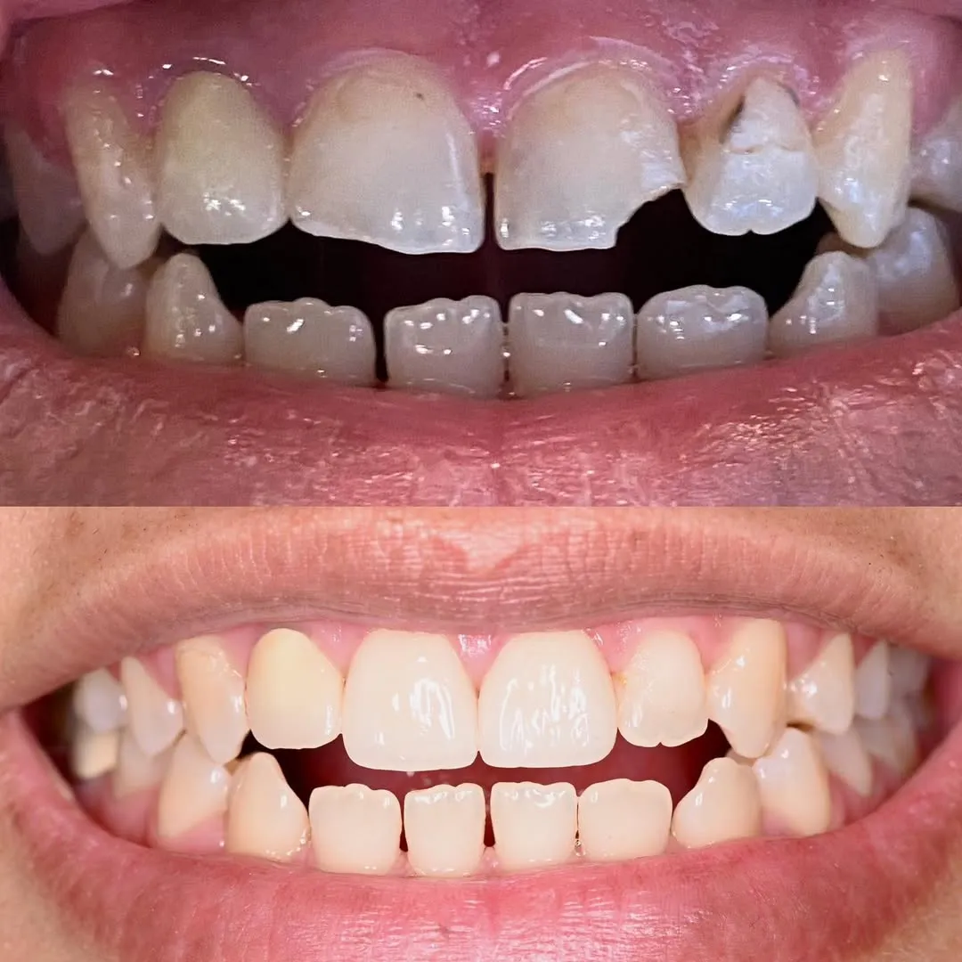 Before and after smile improvement using custom dental veneers and crowns