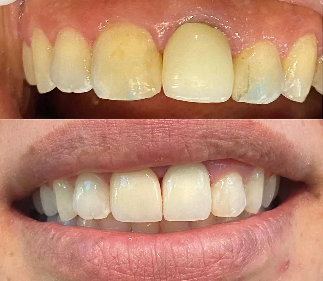 Before and after smile transformation with ceramic veneers and crowns