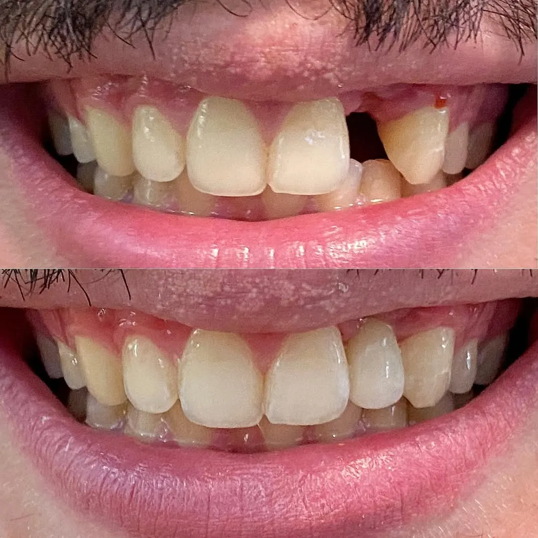 Illustration showing how a dental bridge replaces missing teeth and restores a complete smile