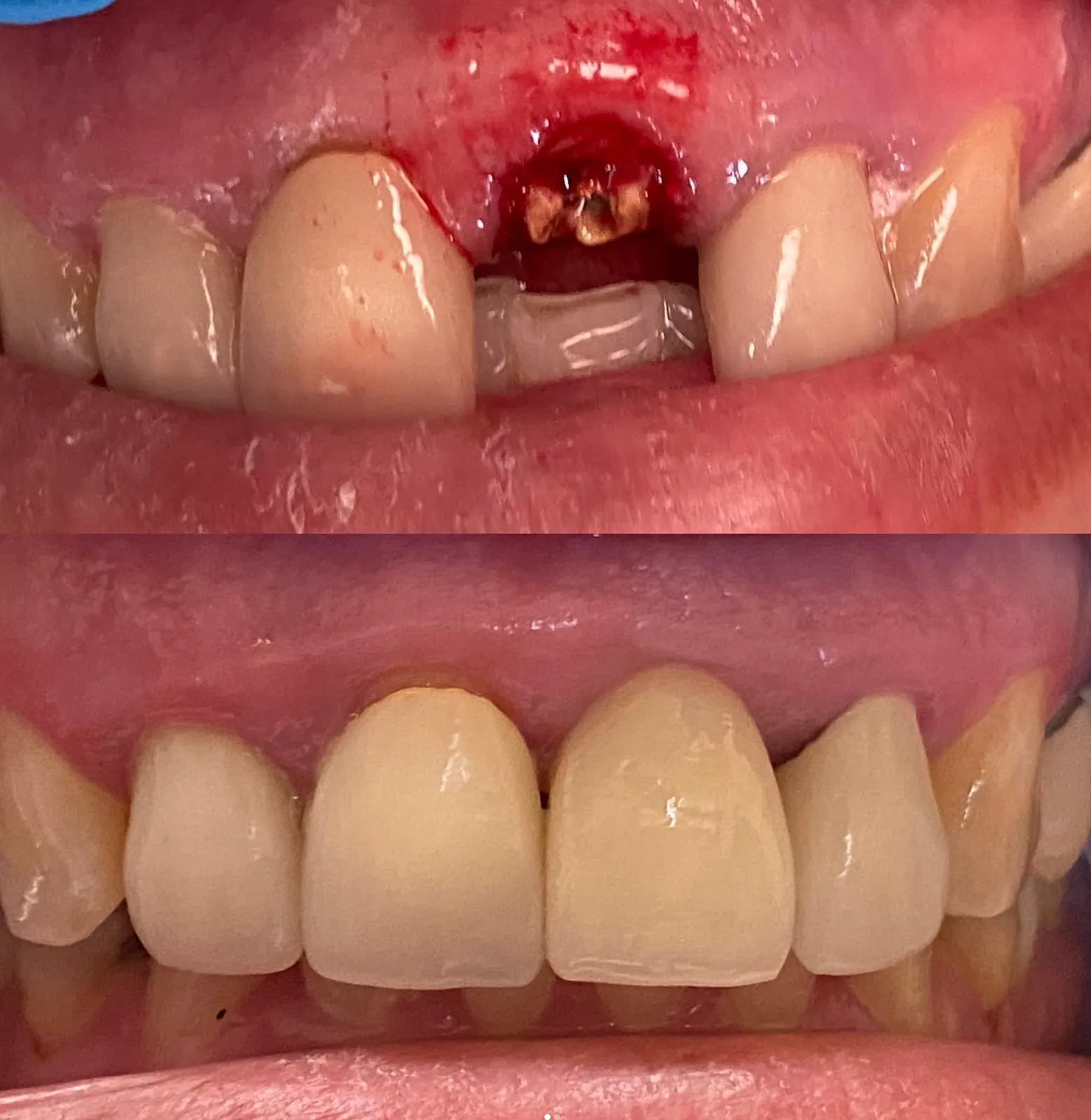 Before and after emergency dental treatment restoring damaged or injured teeth