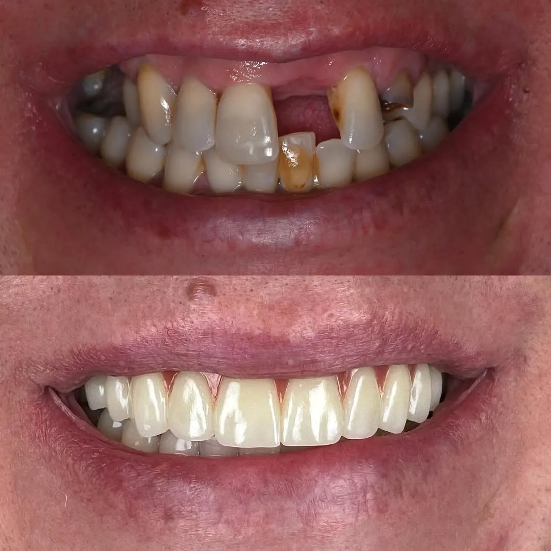 Before and after full-arch restoration using All-On-4 dental implants