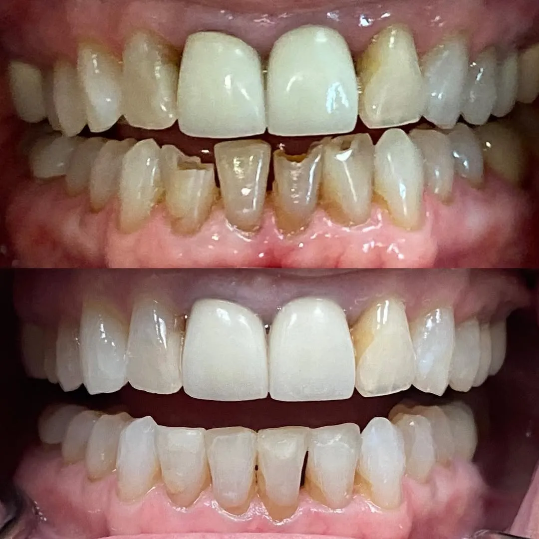Before and after smile makeover showing brighter, straighter, and more confident teeth