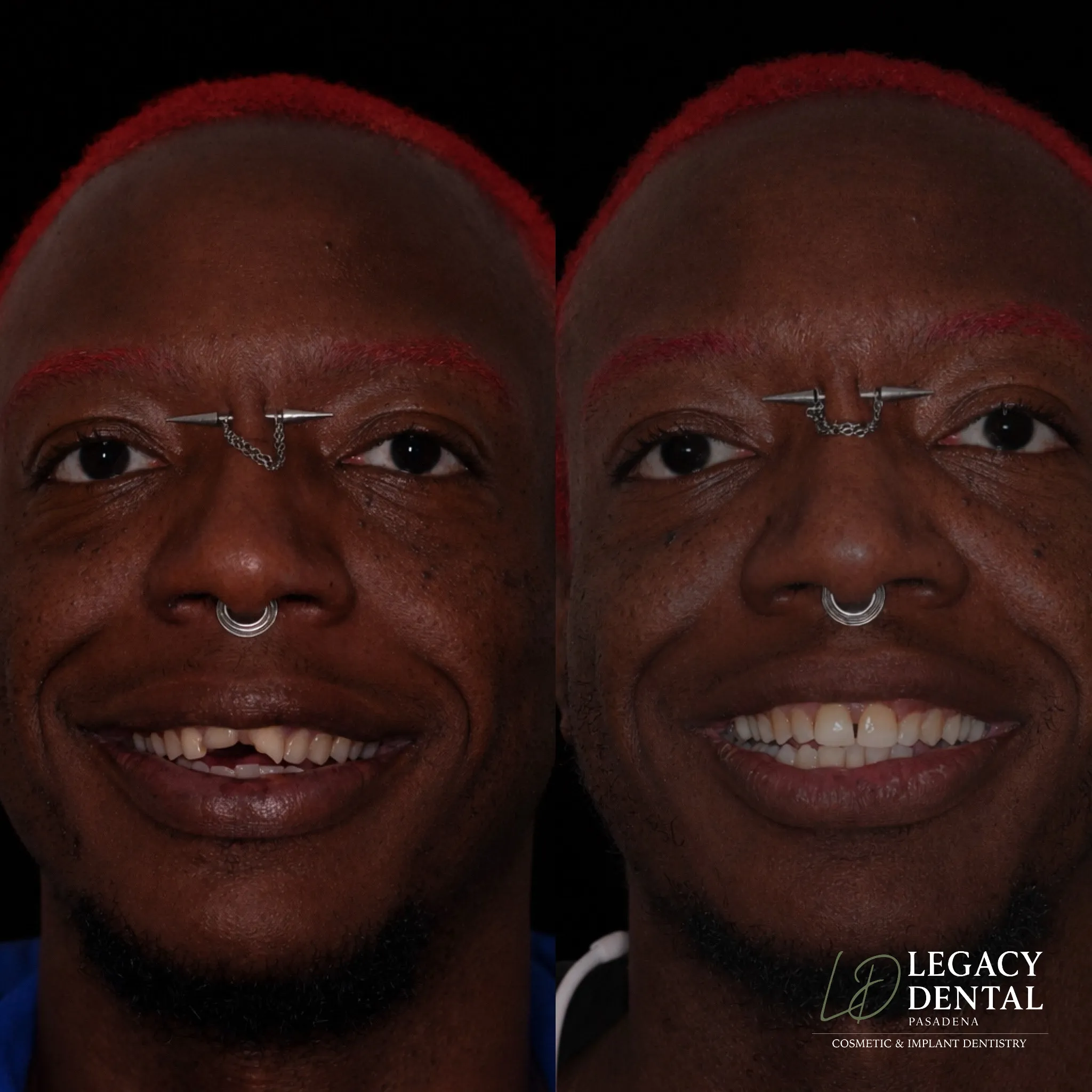 Before and after smile transformation showing cosmetic dental treatment results at Legacy Dental Pasadena.
