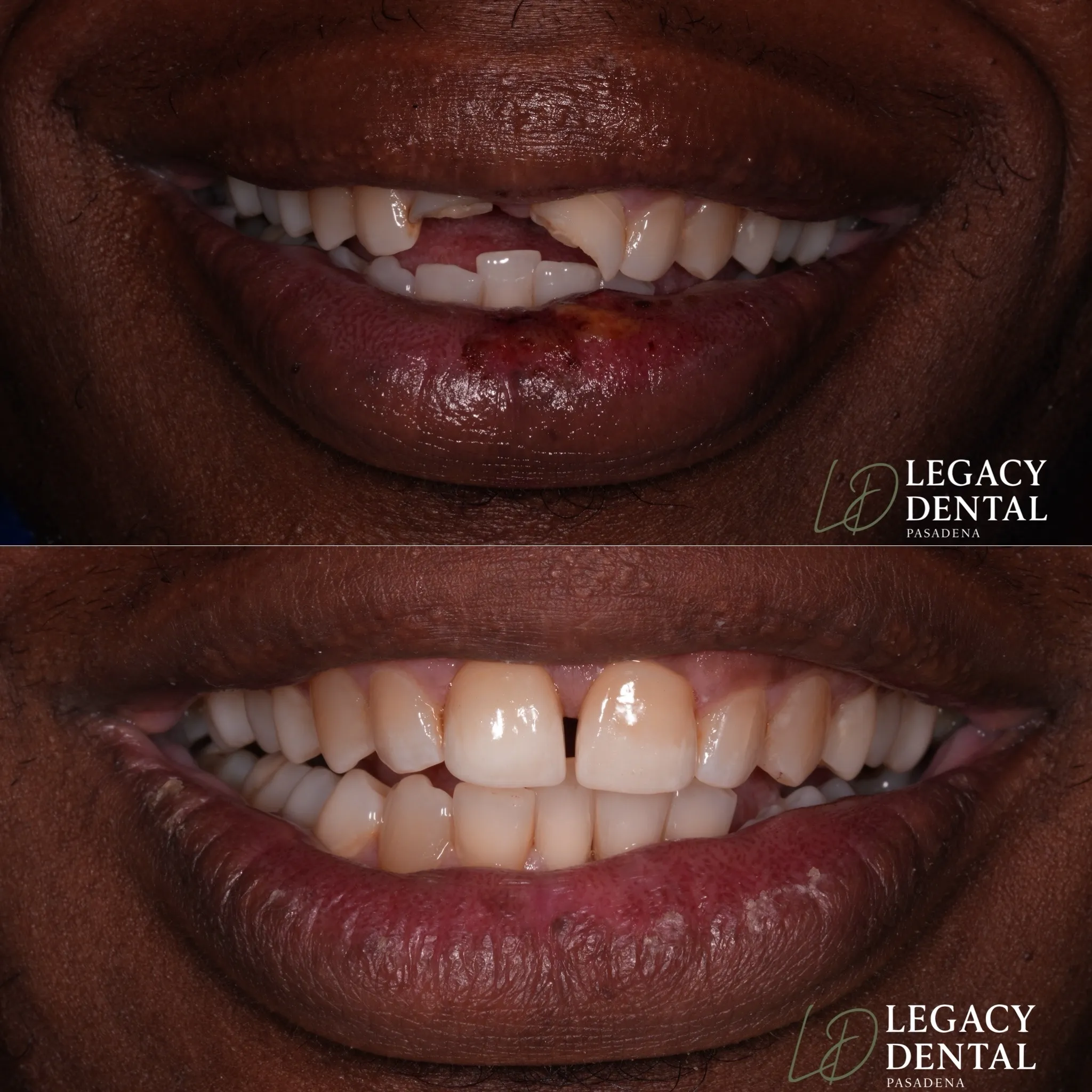 Before and after photos of a cosmetic dentistry smile transformation completed by Legacy Dental Pasadena.